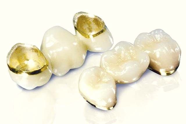 Răng sứ kim loại quý cũng là một lựa chọn được nhiều người lựa chọn khi dùng đến phương pháp trồng và bọc răng sứ