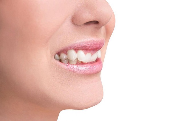 Người có răng bị mọc lệch thường không được khuyến khích dán sứ veneer