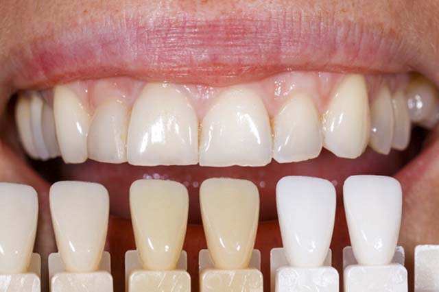 Thói quen ăn uống các món dễ gây xỉn màu răng trong thời gian dài cũng phần nào tác động đến màu răng của răng sứ