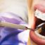 10 điều quan trọng bạn cần lưu ý kỹ khi niềng răng, chỉnh nha