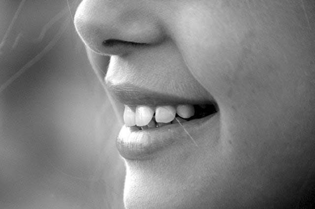 Các trường hợp răng hô nhẹ có thể dùng phương pháp mài răng cửa