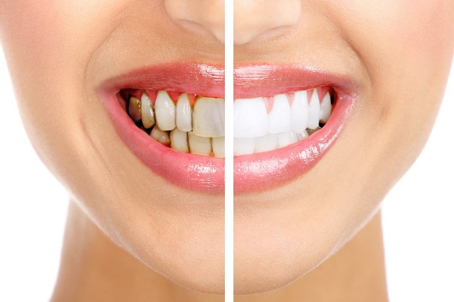 Dán sứ veneer giúp hàm răng của bạn trông đều, đẹp và tỏa sáng hơn