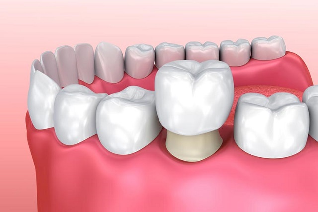 Bọc răng sứ là giải pháp tối ưu dành cho trường hợp không thể thực hiện dán sứ