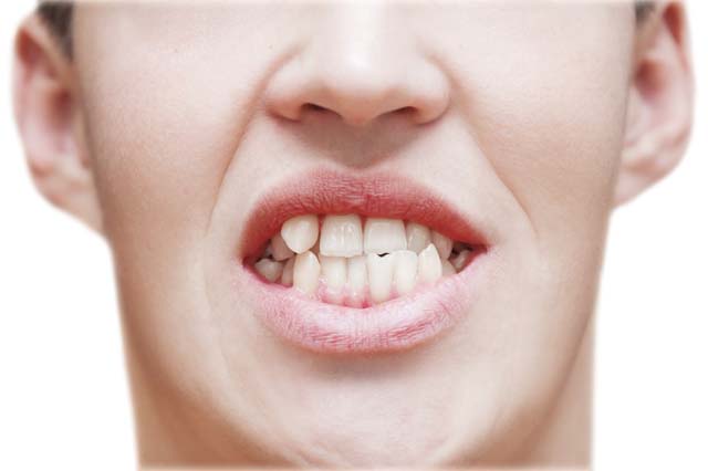 Người có răng mọc sai lệch khỏi vị trí cần phải lấy tuỷ để qúa trình bọc răng sứ không ảnh hưởng đến nguy cơ đau nhức và nhiễm trùng