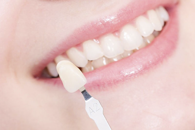 Veneer cũng là một lựa chọn khác nếu bạn không muốn bọc răng sứ ngay sau khi nhổ răng
