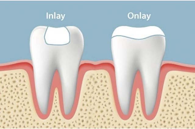 Inlay, onlay sứ là phần phục hồi bằng sứ, dán lên bề mặt răng, sau khi đã loại bỏ đi mô răng hư tổn