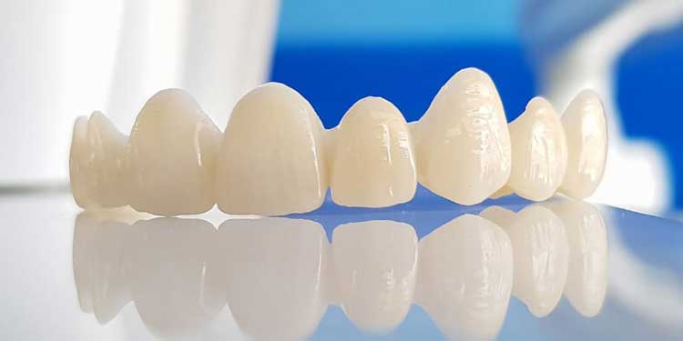 Những thắc mắc thường gặp trong phương pháp bọc răng sứ