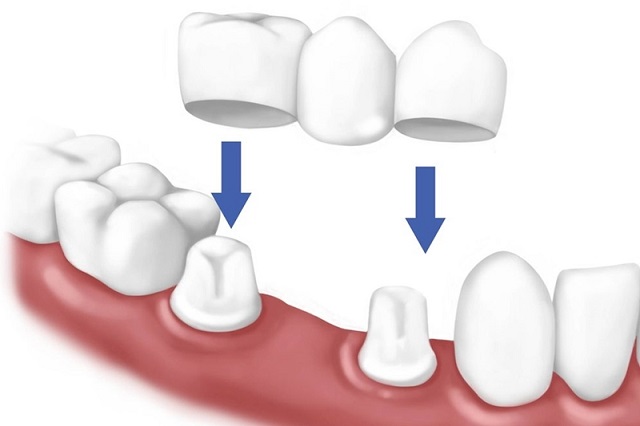 Làm cầu răng sứ là giải pháp hữu hiệu dành cho trường hợp bị mất răng