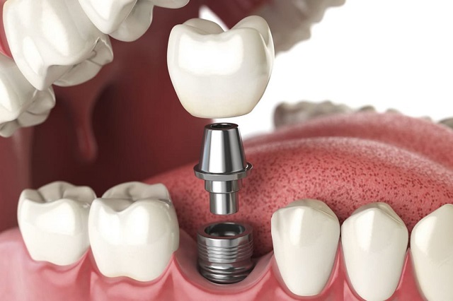 Bọc răng sứ Implant mất nhiều thời gian hơn so với các phương pháp bọc răng sứ khác