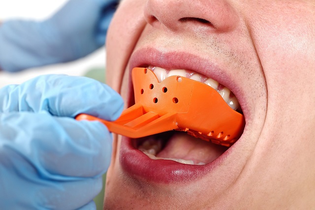 Việc lấy dấu răng để giúp chế tác mặt dán sứ Veneer phù hợp