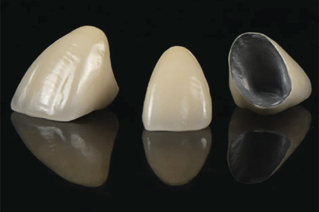 Răng sứ kim loại thường sẽ có màu đục, ít trắng sáng