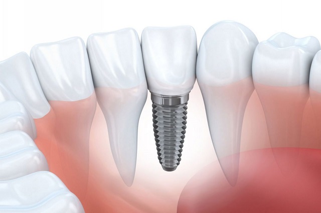 Cấy ghép implant giúp bạn có một chiếc răng hoàn chỉnh về chức năng ăn nhai lẫn thẩm mỹ